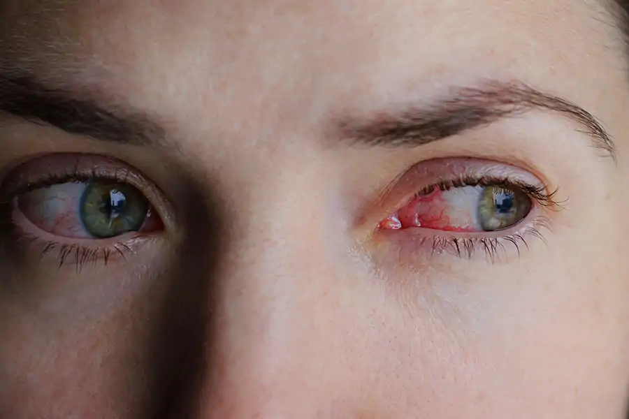 konjunktivitis